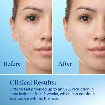 Differin Acne Retinoid Face and Body Treatment Gel Adapalene 0.1% 15g - Imperfect Box