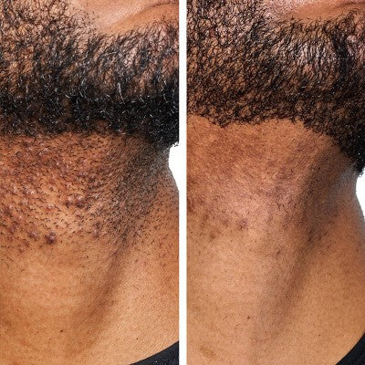 Urban Skin Rx Men's Daily Razor Bump + Dark Spot Treatment 1.7 fl oz - New